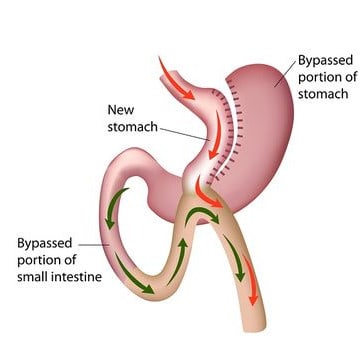 schéma bypass estomac